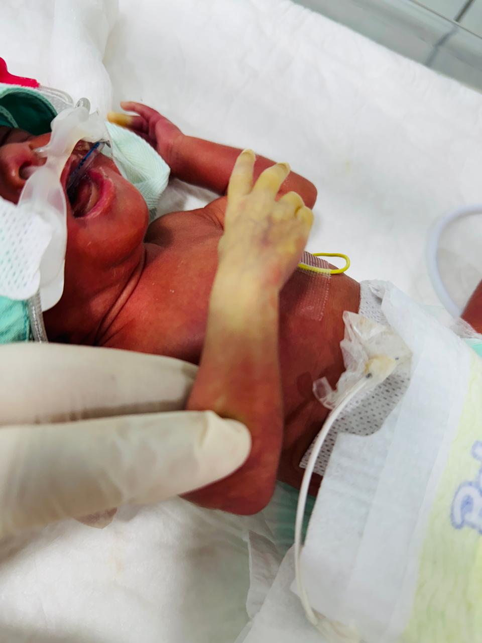 علاج متلازمة الرجل الاحمر